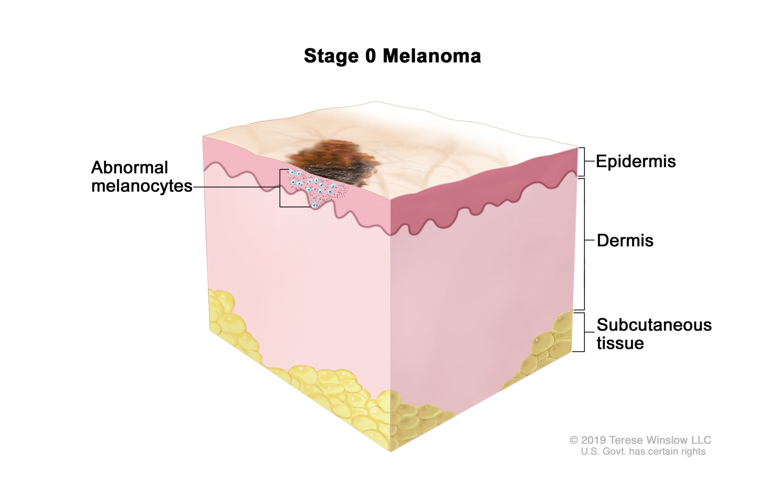 Melanoma in Dogs: What You Need to Know